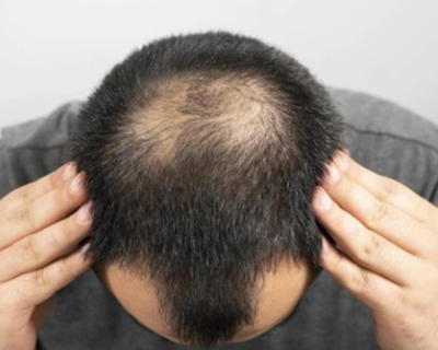 4 Điều Cần Biết Khi Bị Hói Đầu Ở Nam Giới