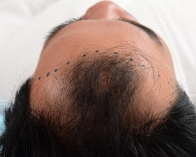 Ngăn Ngừa Hói Đầu An Toàn, Hiệu Quả
