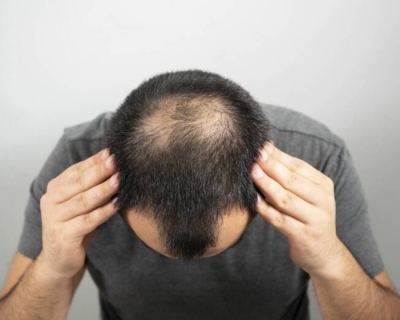 Nguyên Nhân Rụng Tóc Ở Đỉnh Đầu Là Gì?