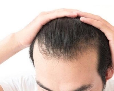 Nguyên Nhân Rụng Tóc Ở Nam, Cách Điều Trị