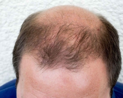 Rụng Tóc Androgen Là Gì? [GIẢI ĐÁP]