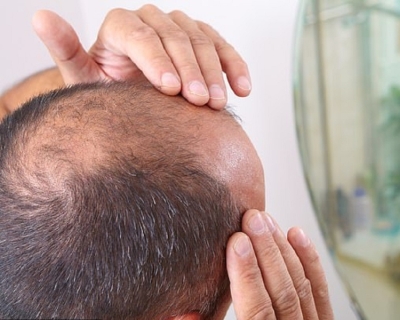 Rụng Tóc Do Gen Di Truyền Có Cách Nào Khắc Phục Không?